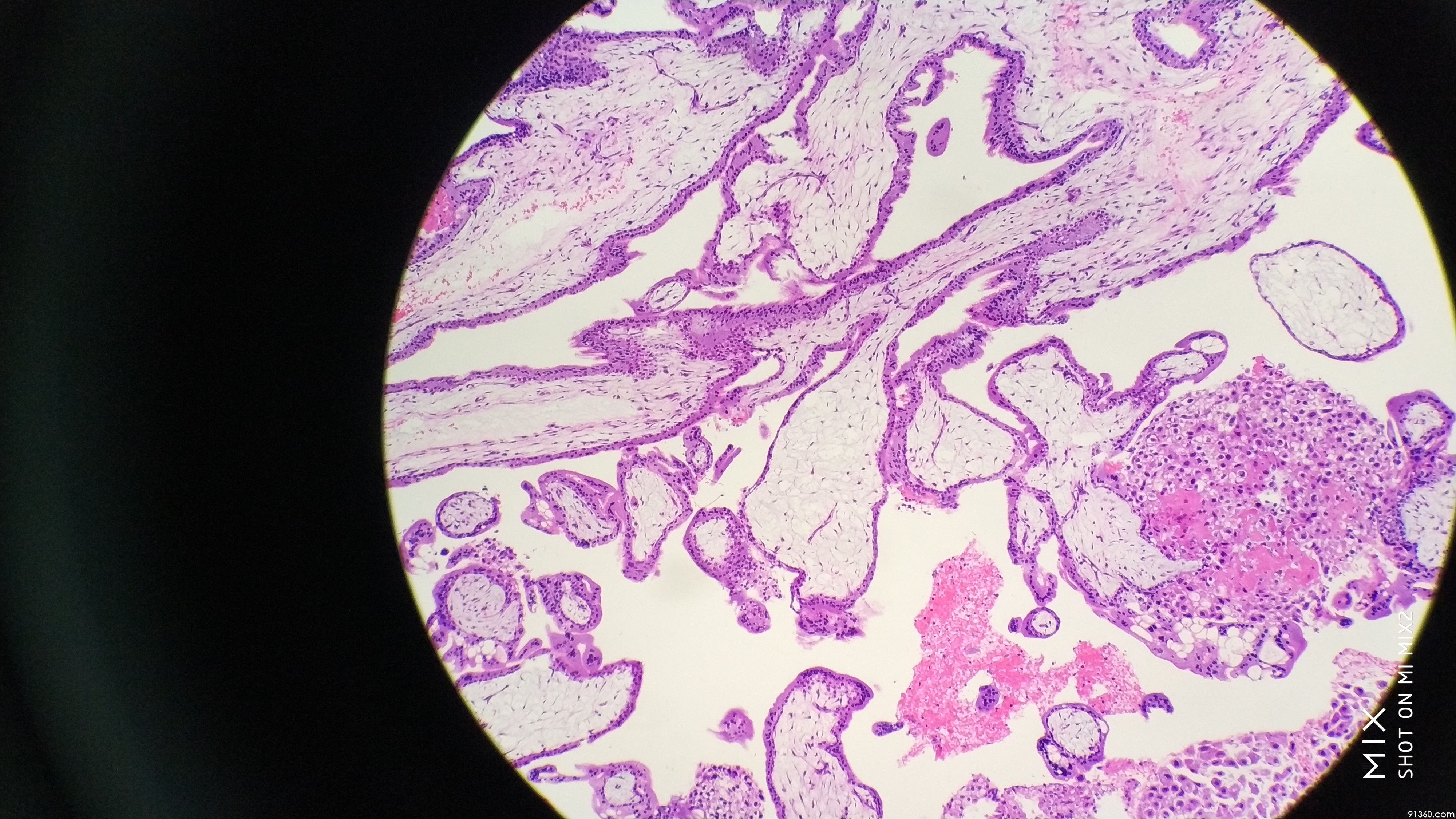 葡萄胎?p57表达如何判读?讨论病例【中美加子宫内膜病理交流群473】