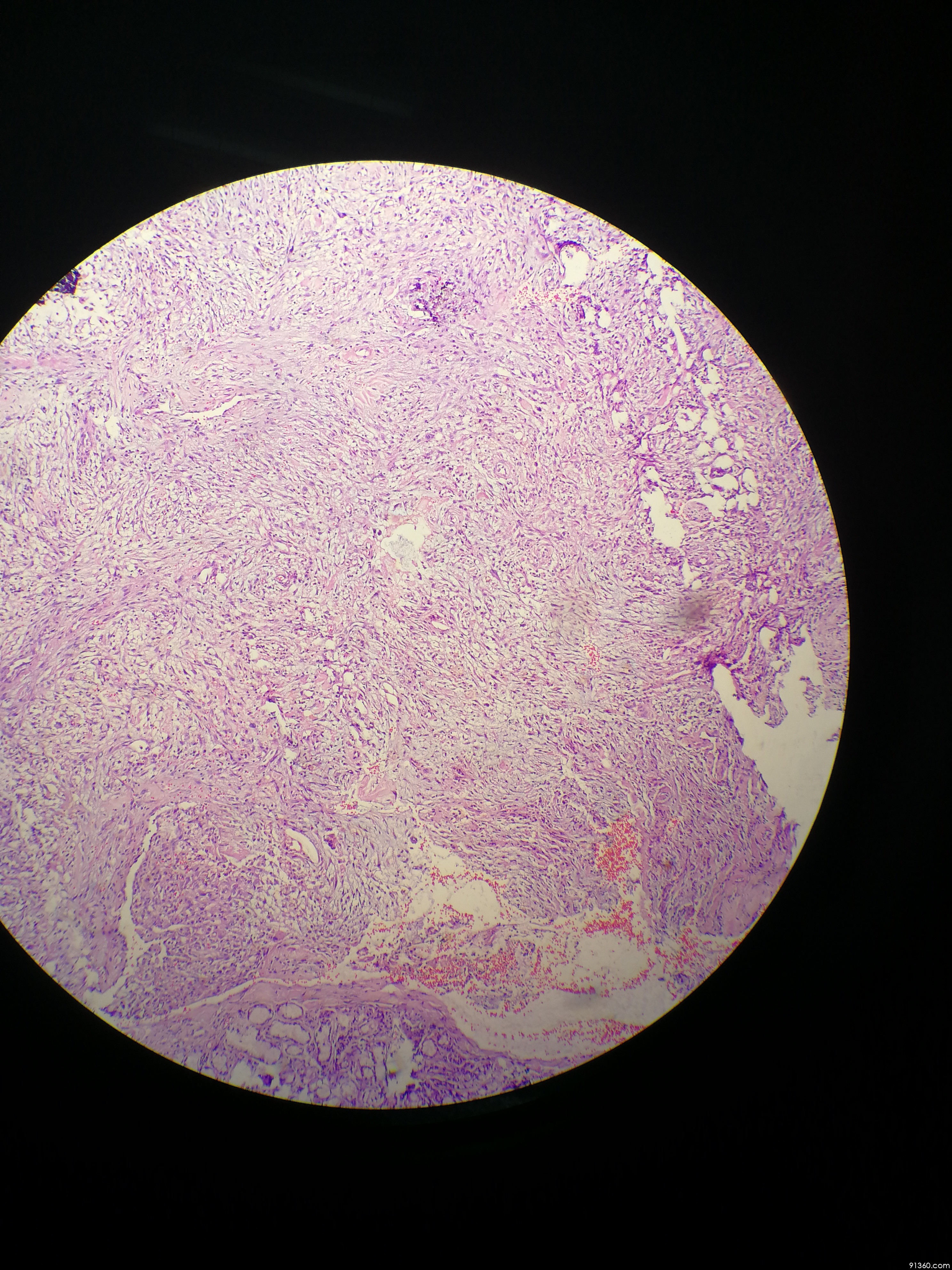 结节性筋膜炎?讨论病例【91360.软组织148】