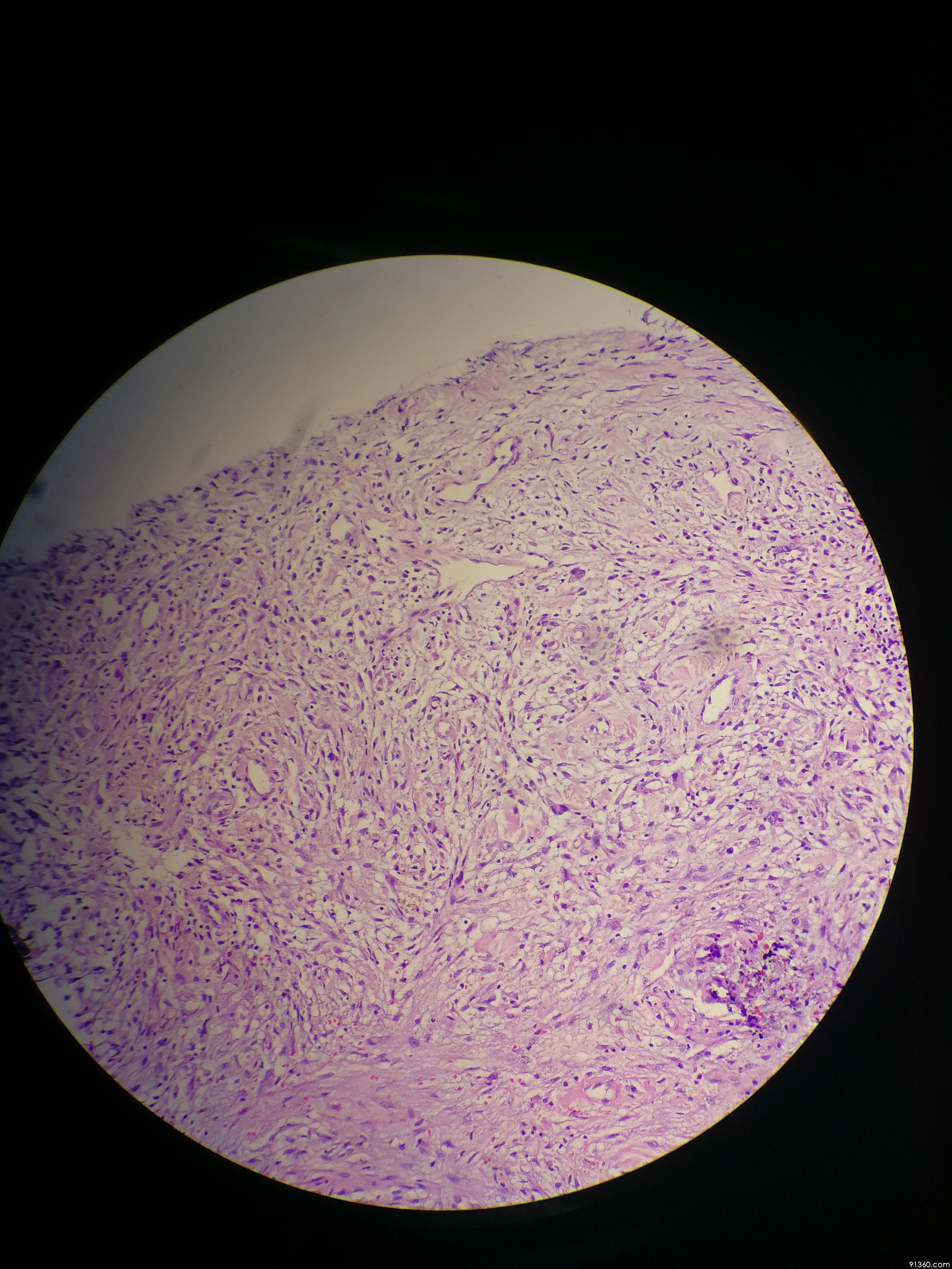 结节性筋膜炎?讨论病例【91360.软组织148】