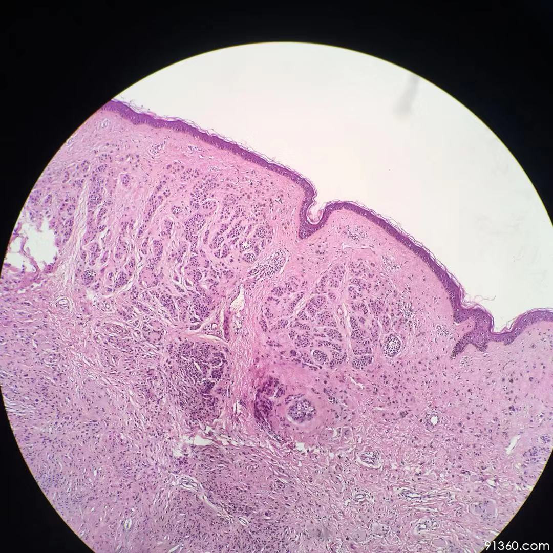皮内痣病理图片图片
