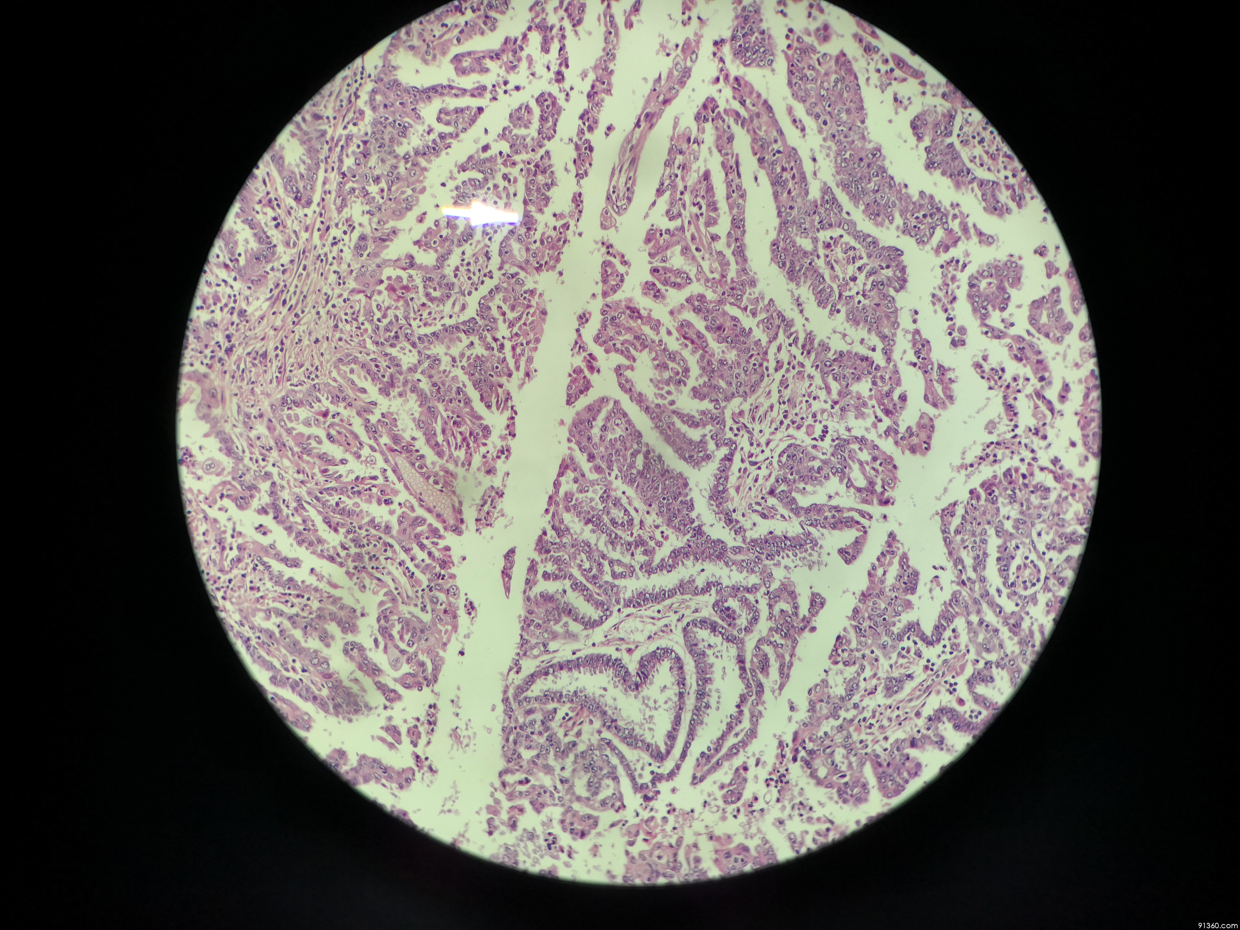 浆液性癌?讨论病例【中美加子宫内膜病理交流群501】