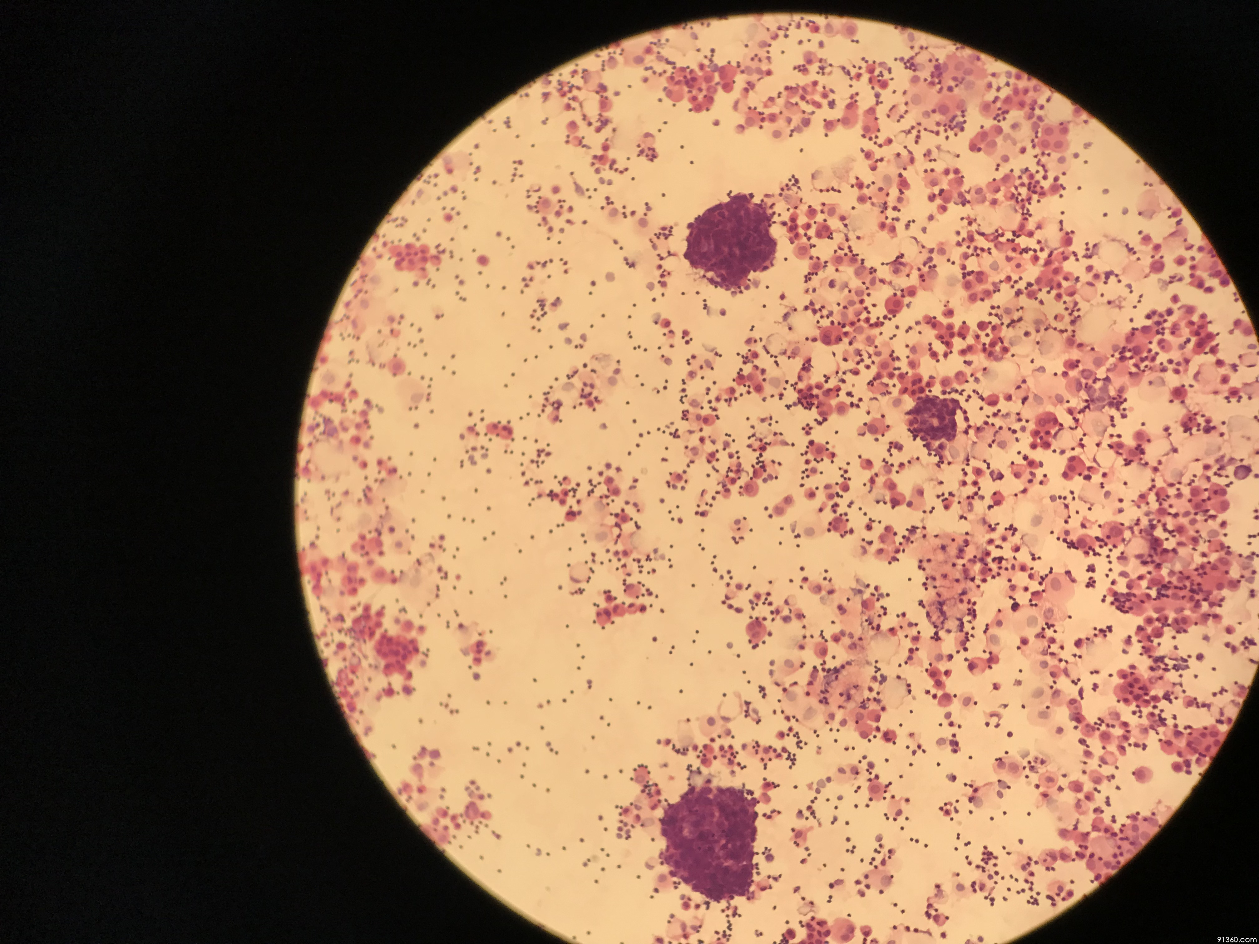 右肾上极占位性病变,送检胸水 小细胞神经内分泌癌?