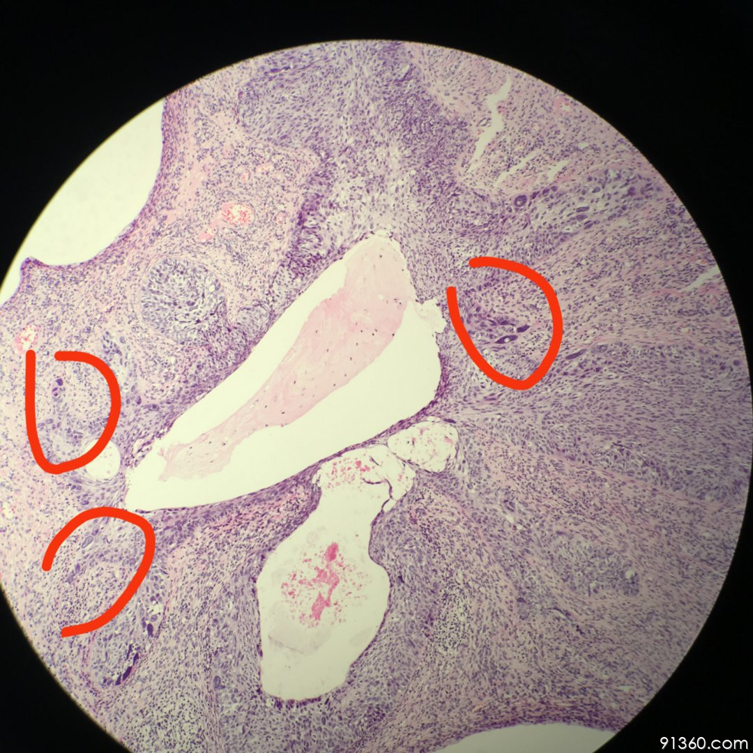 浸润?【中美加宫颈病理交流群病例1084】