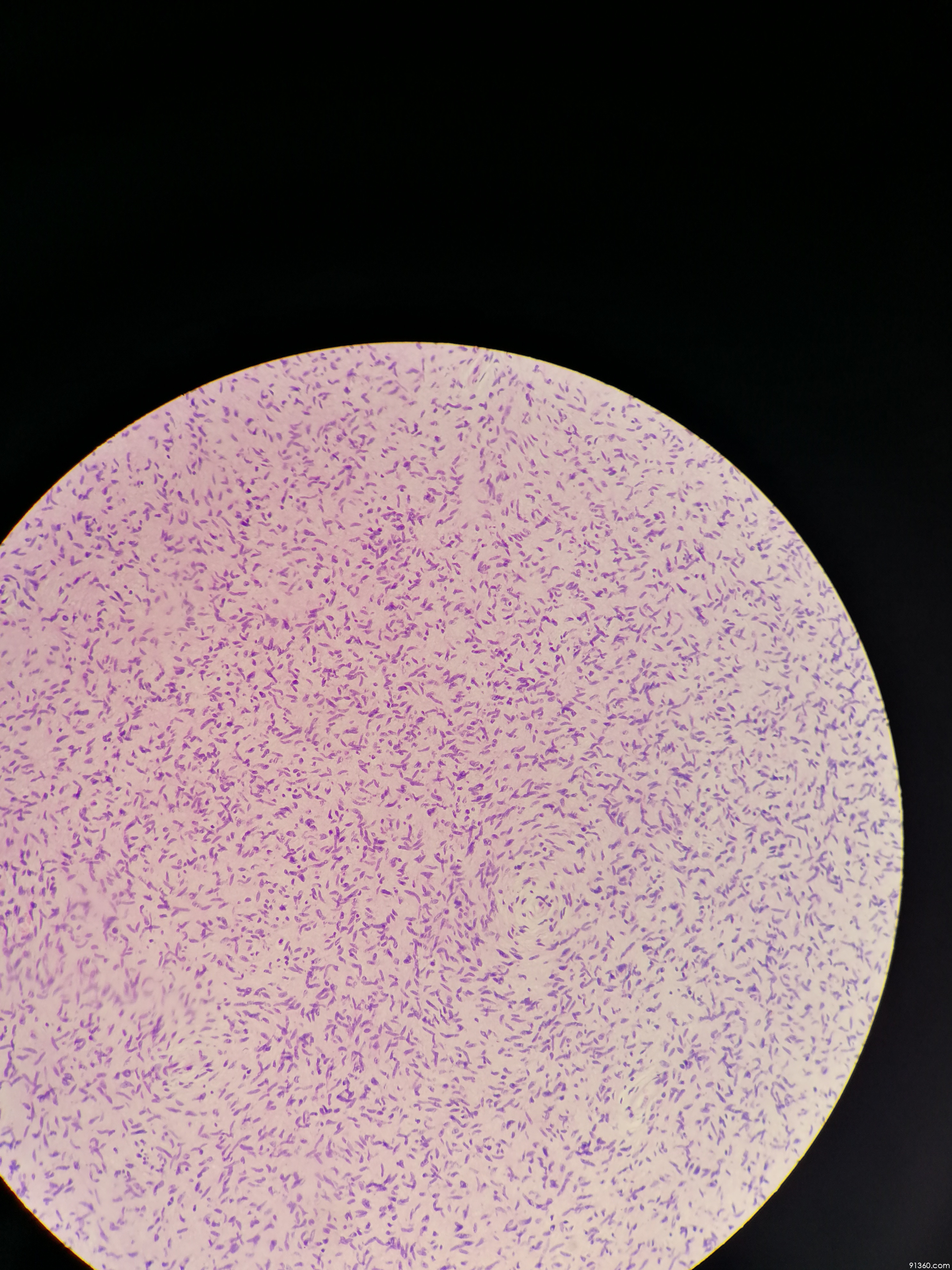 神经纤维瘤?讨论病例【91360.软组织265】