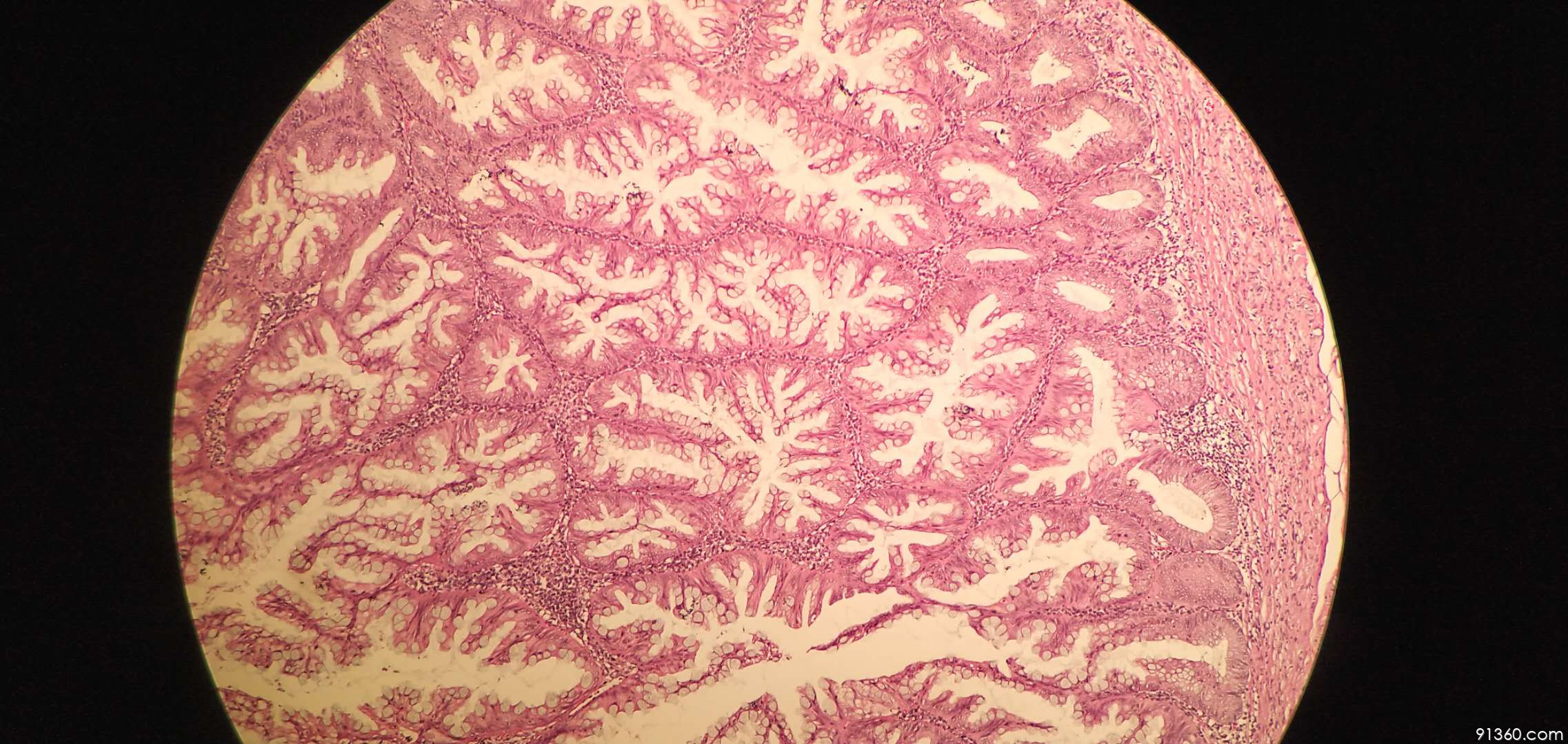 锯齿状腺瘤病例讨论2019.06.02【91360消化病理沙龙病例讨论422】