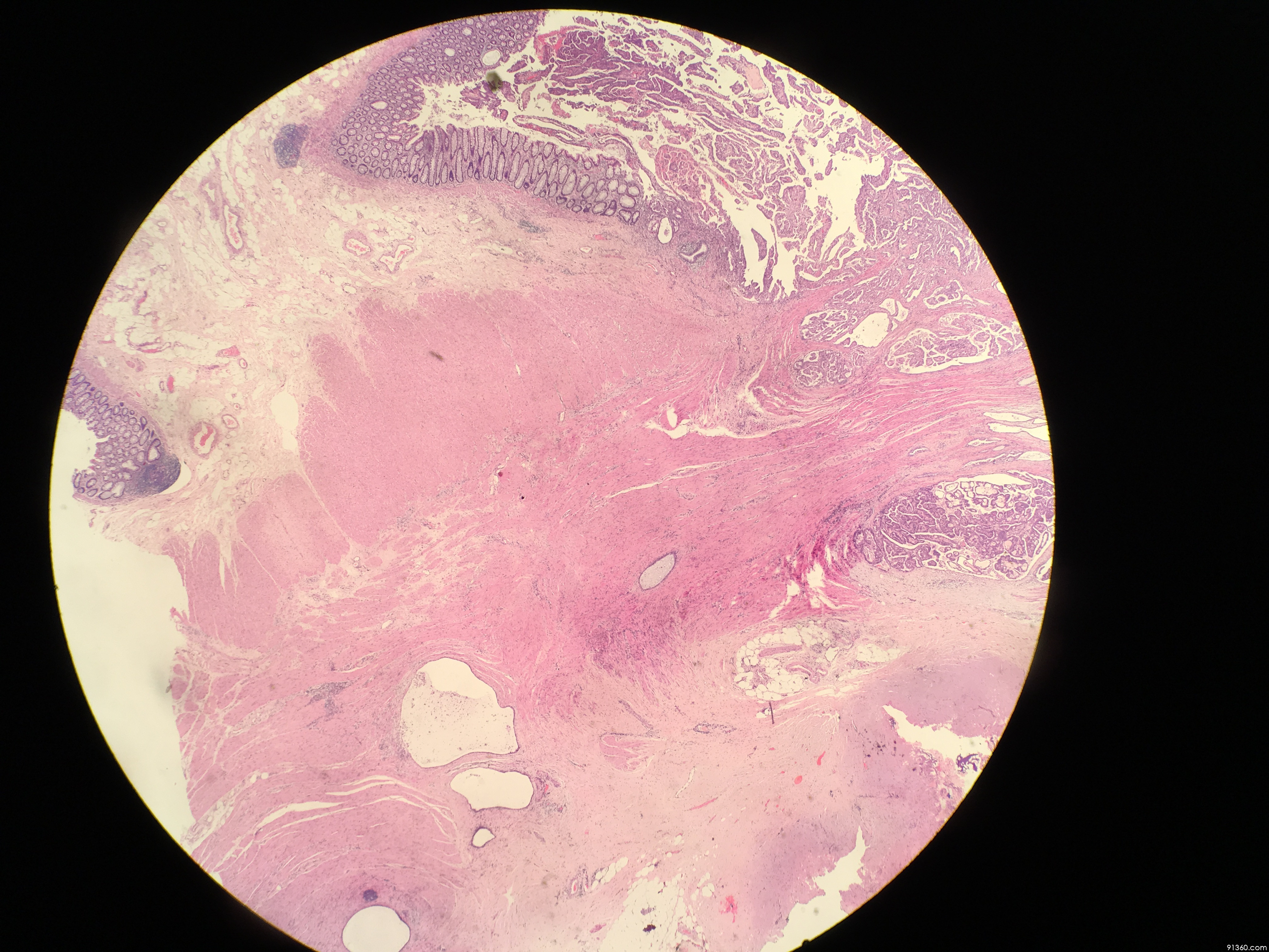 内膜异位症基础上发生的透明细胞癌【中美加卵巢肿瘤病理交流群405】