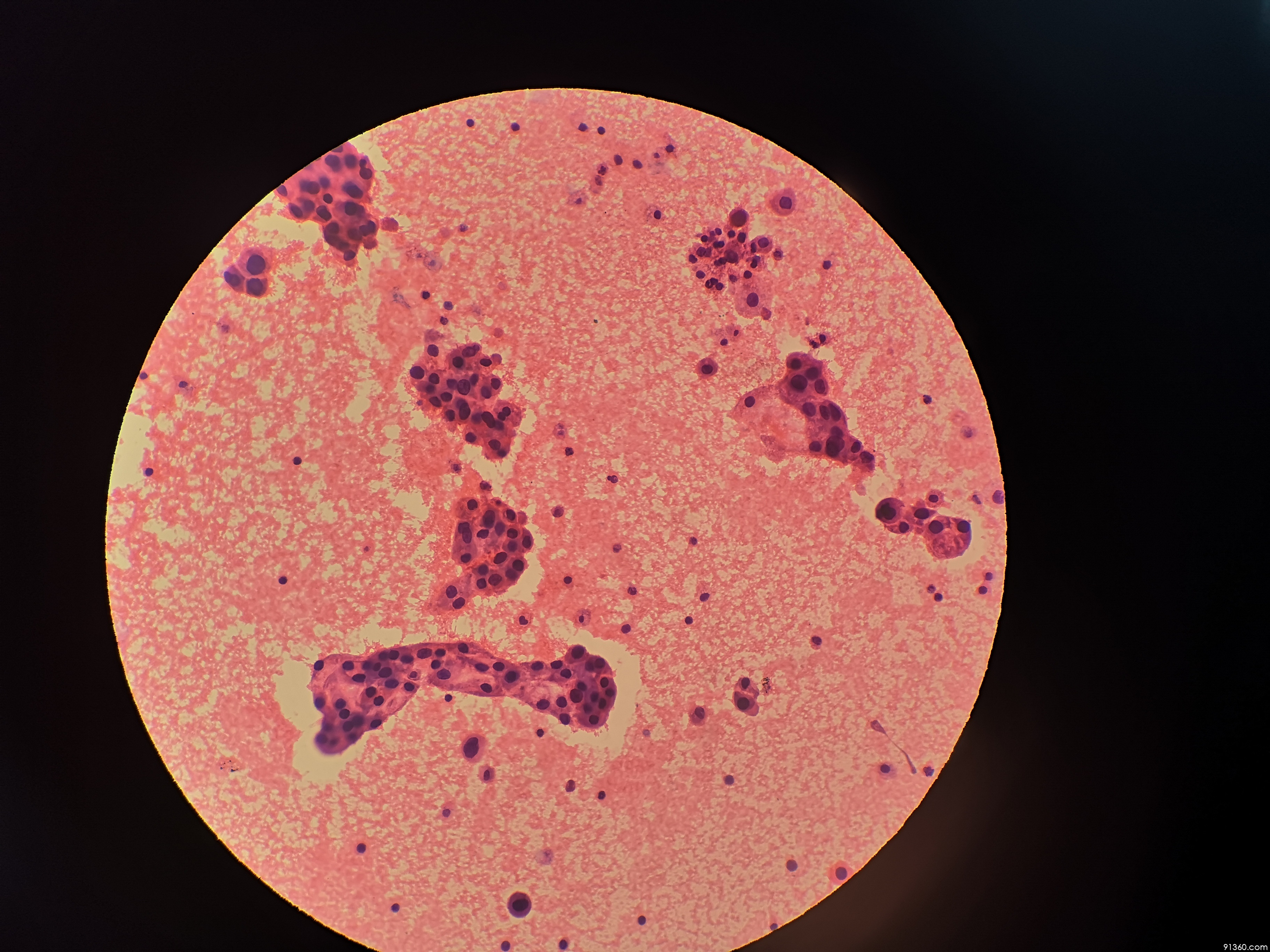 腺癌?讨论病例【中美加非妇科病理交流群病例308】