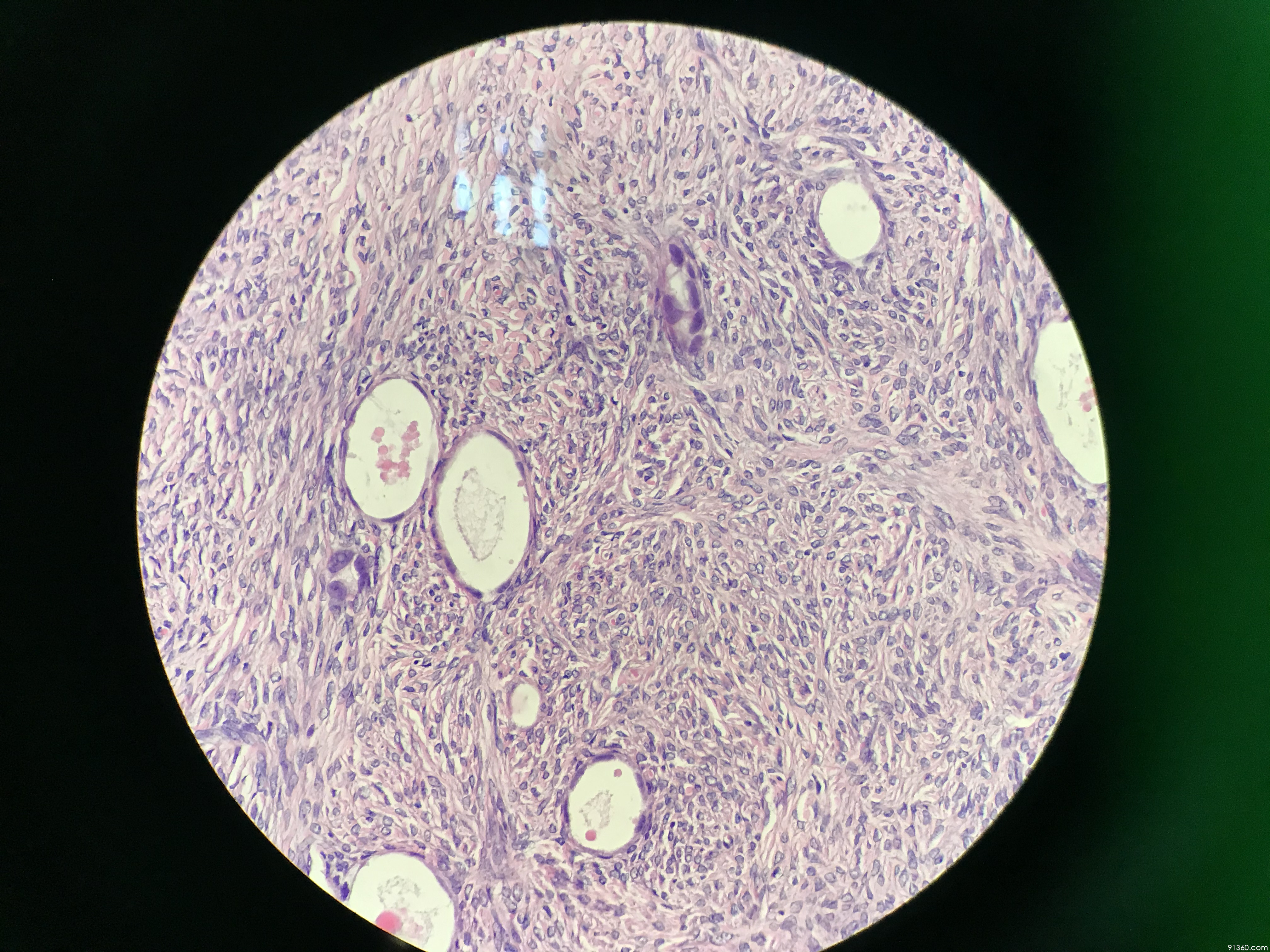 卵巢交界性透明细胞肿瘤,高度怀疑ccc【中美加卵巢肿瘤病理交流群473