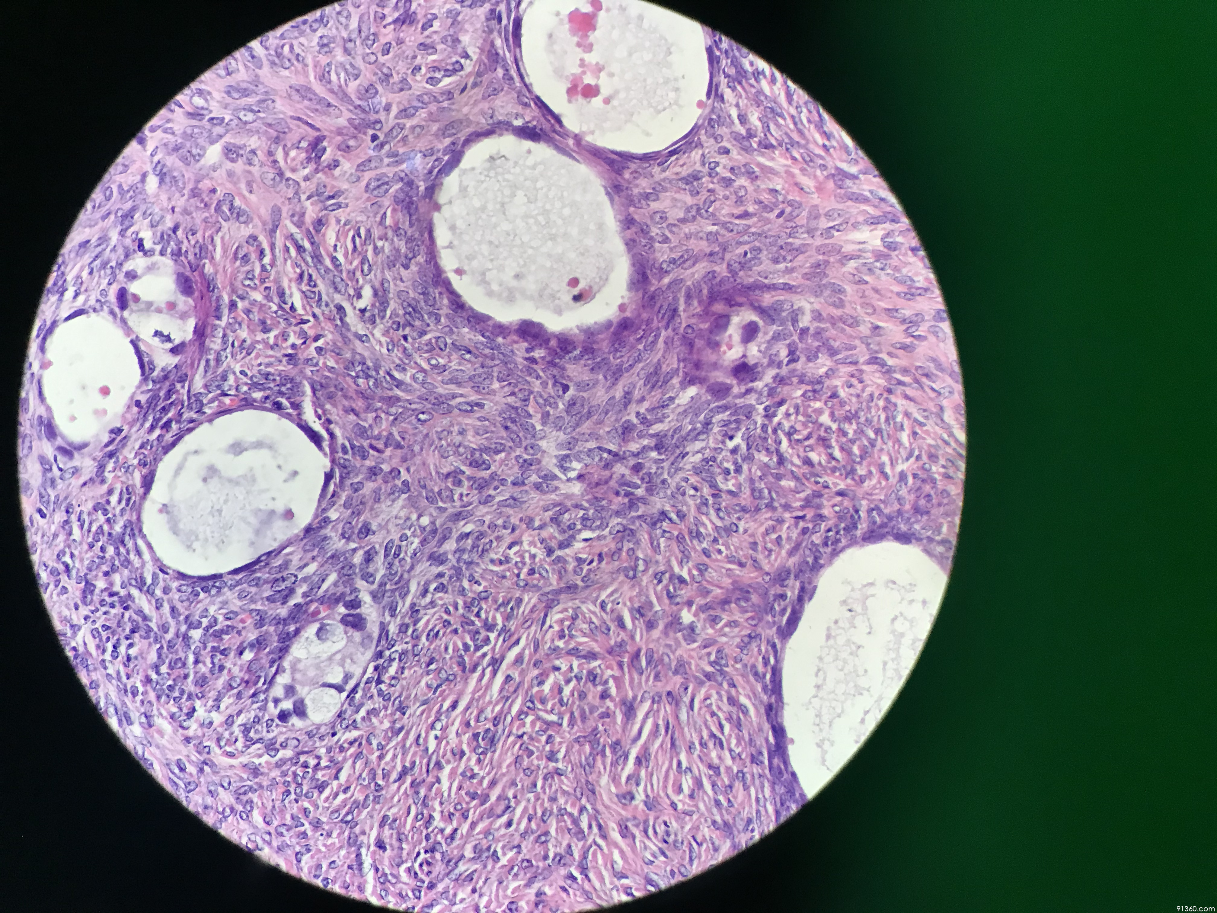 卵巢交界性透明细胞肿瘤,高度怀疑ccc【中美加卵巢肿瘤病理交流群473