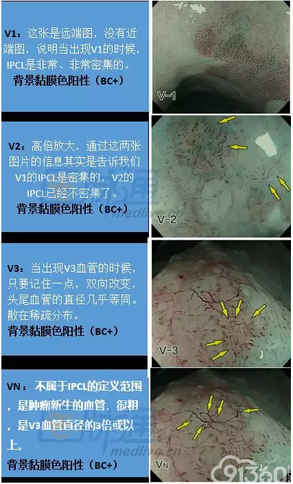 早期食管癌诊断基础