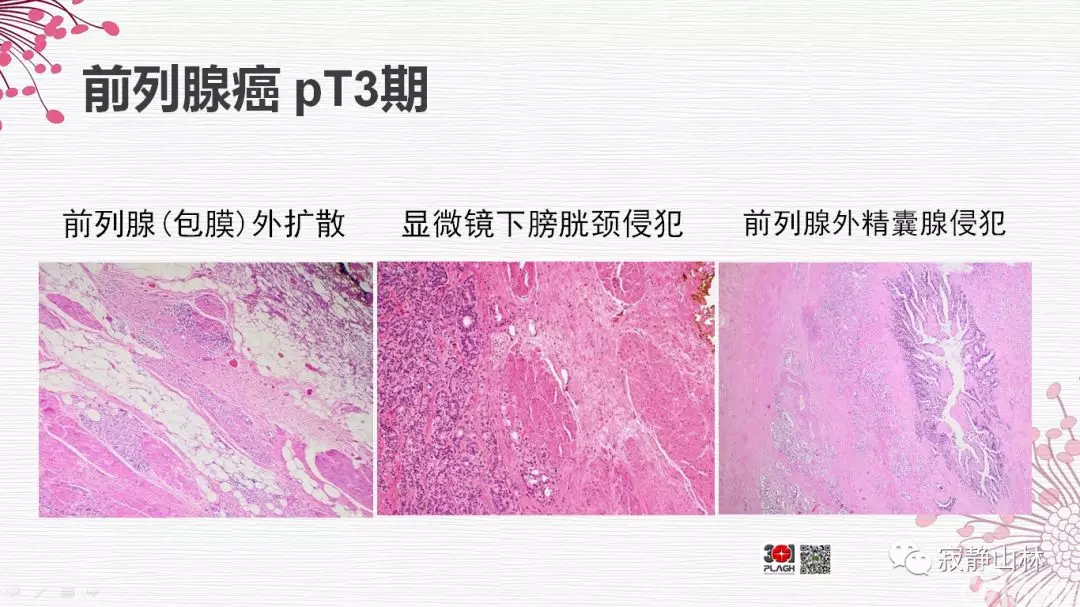 晚期前列腺癌的病理学诊断