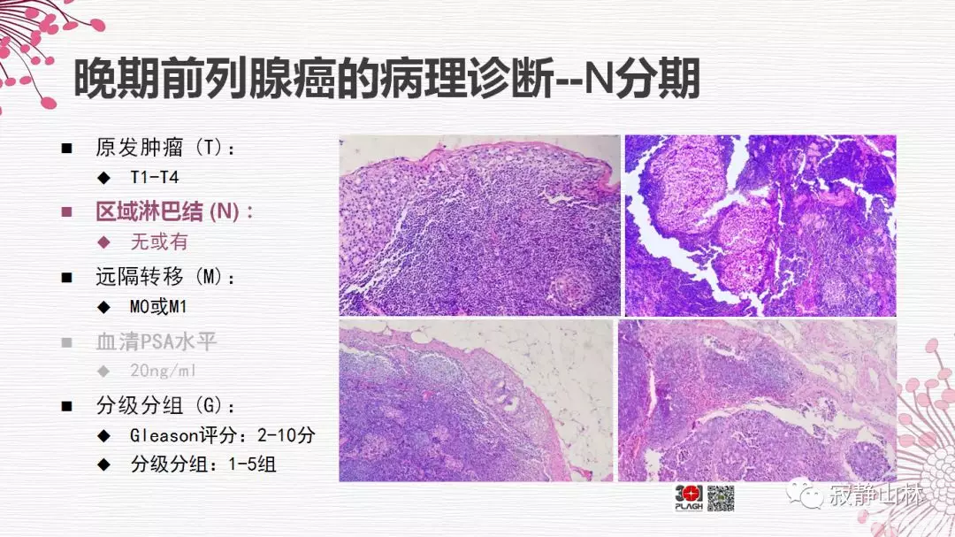 晚期前列腺癌的病理学诊断