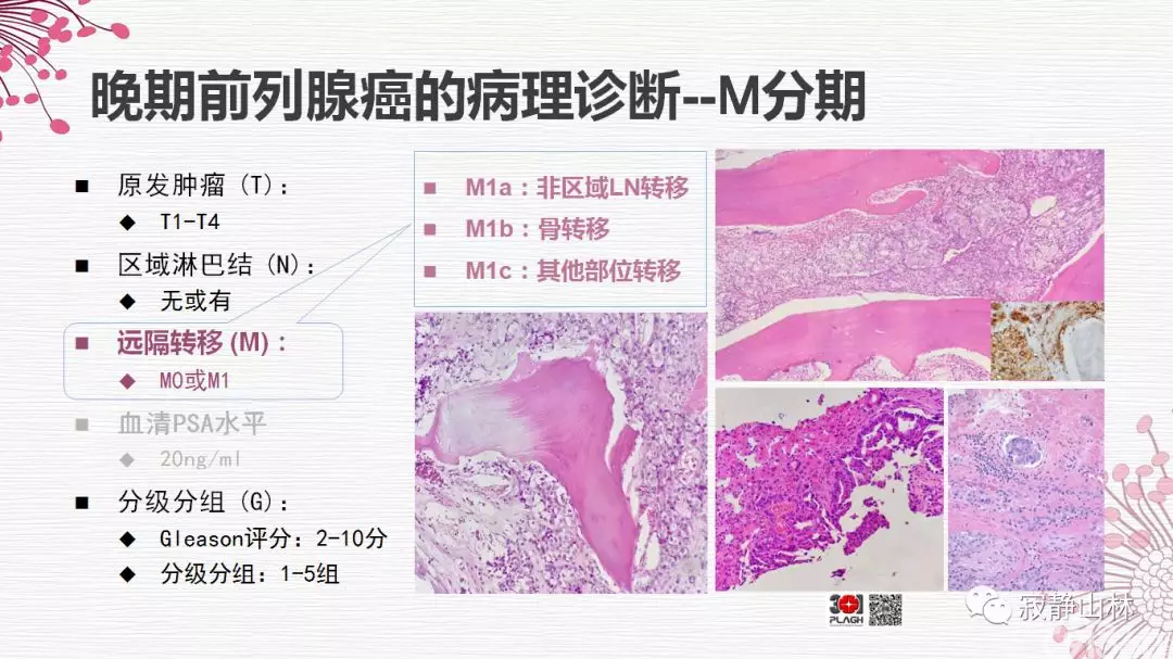 晚期前列腺癌的病理学诊断