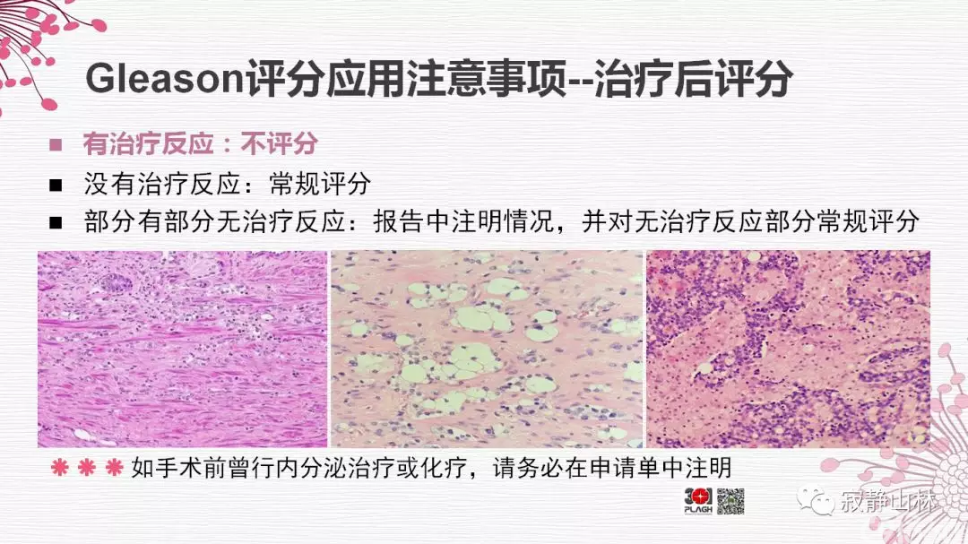 晚期前列腺癌的病理学诊断