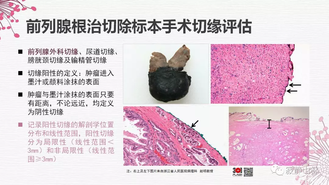晚期前列腺癌的病理学诊断