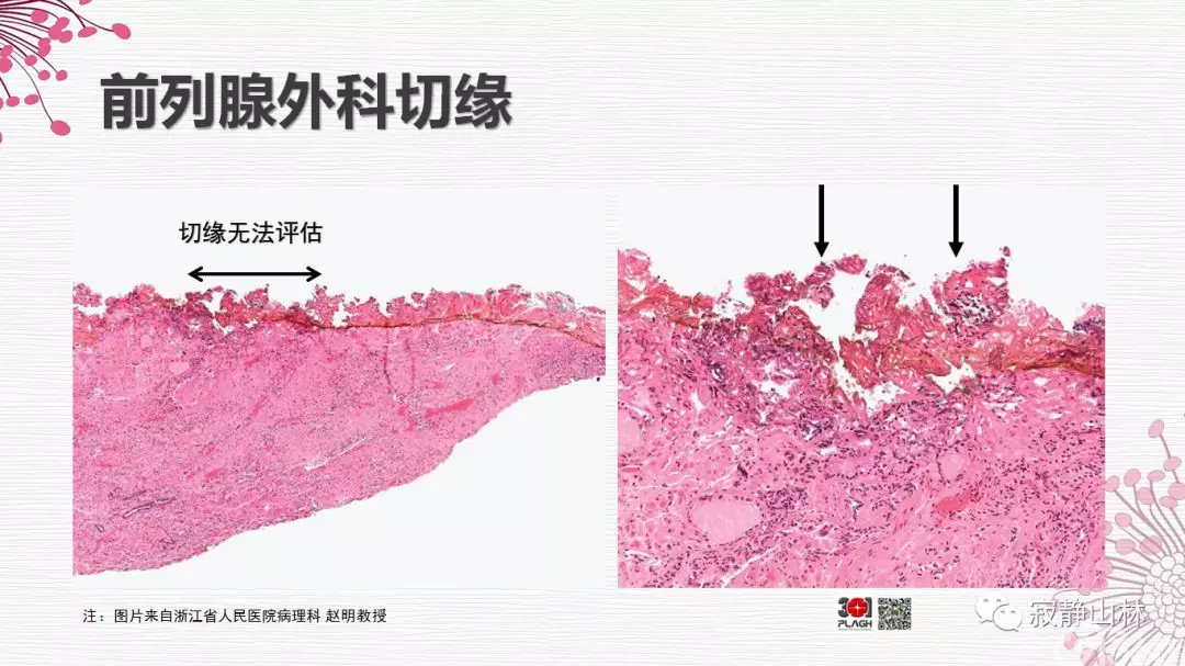 晚期前列腺癌的病理学诊断