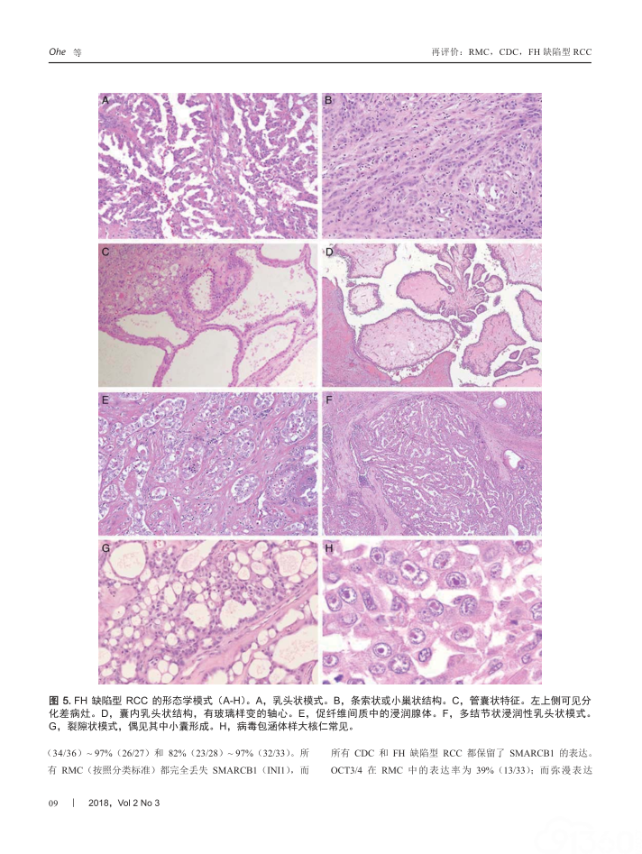 重新评估肾髓质癌、集合管癌和延胡索酸水合酶缺陷型肾细胞癌的形态学差异