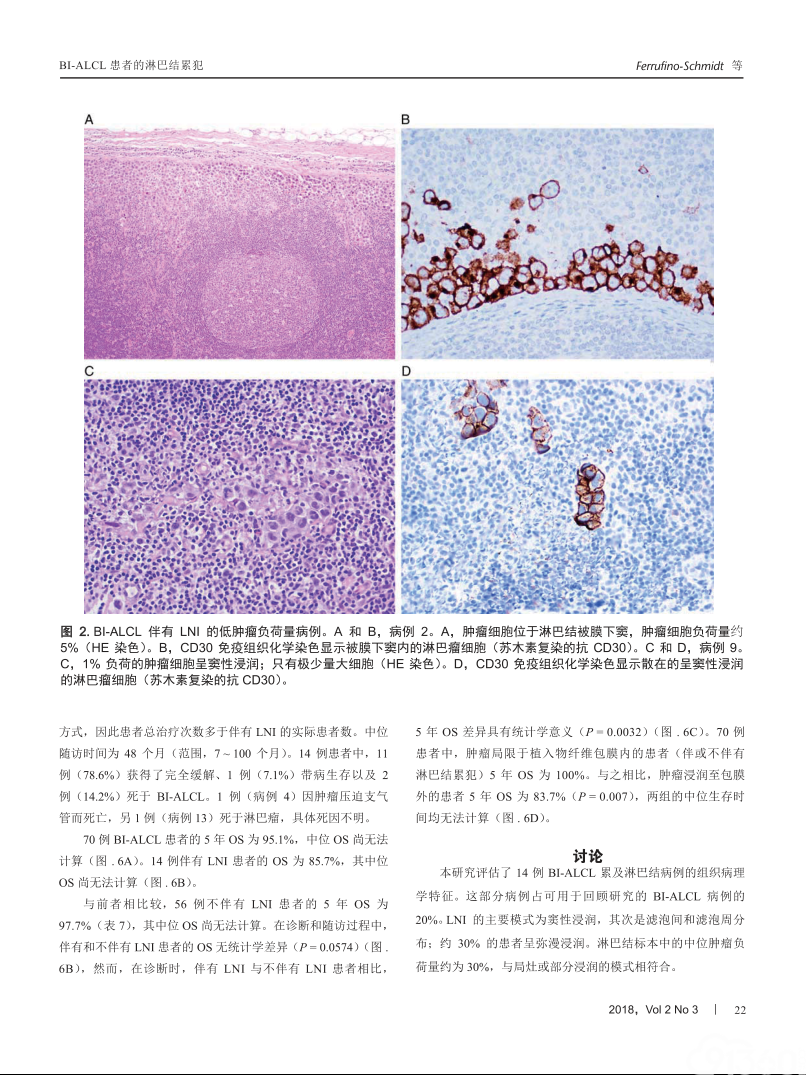乳腺植入物相关性间变性大细胞淋巴瘤患者淋巴结累犯的临床病理特征和患者的预后影响