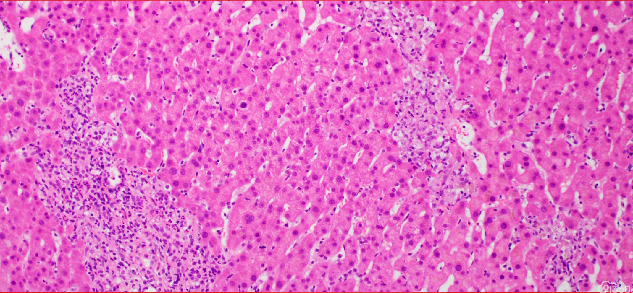 USCAP 2019 消化系统病变主要内容总结