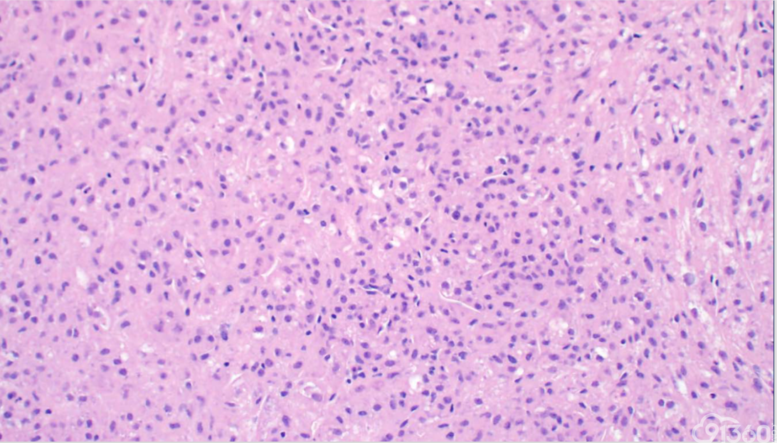USCAP 2019 消化系统病变主要内容总结