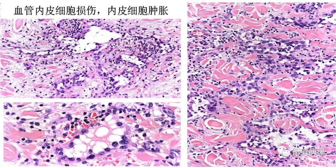 血管内膜受损,心内膜垫缺损,内膜(第2页)_大山谷图库