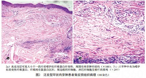 病例报告 泛发型环状肉芽肿一例 91360智慧病理网
