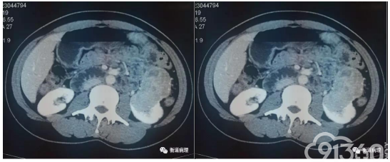病理文汇 丨 一例罕见分型肾脏肿瘤的病理解析