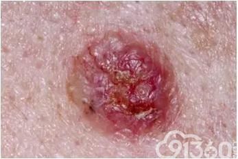 上海发布:大肠癌、肺癌、乳腺癌、肝癌、胃癌、甲状腺癌等14种恶性肿瘤筛查与预防指南