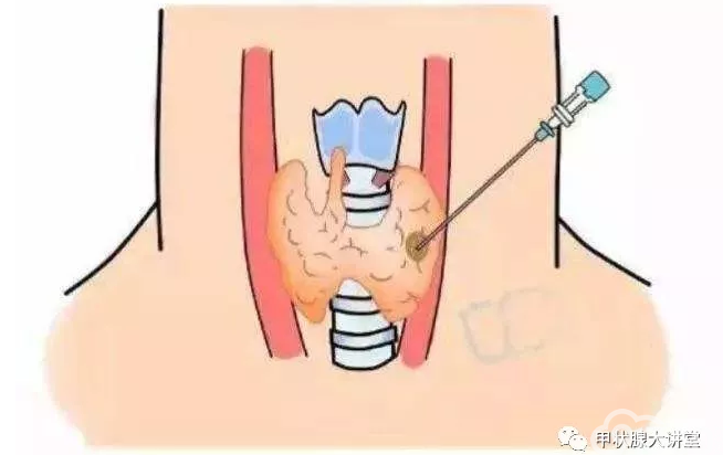 甲状腺结节癌变率大吗?严重会致命吗?专家:这点很重要!