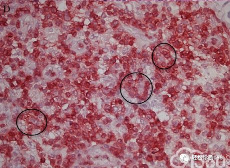 滤泡辅助T细胞(TFH)及其相关淋巴瘤(8)