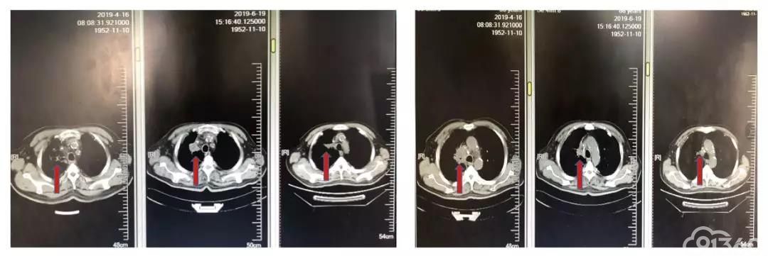 TMB高表达晚期肺鳞癌患者