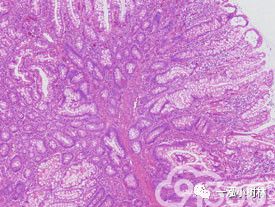 回盲部肿瘤性病变 智慧病理网