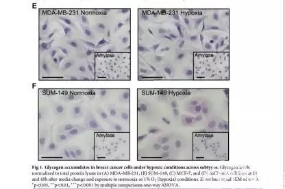 乳腺癌如何转移?这些研究提供新思路