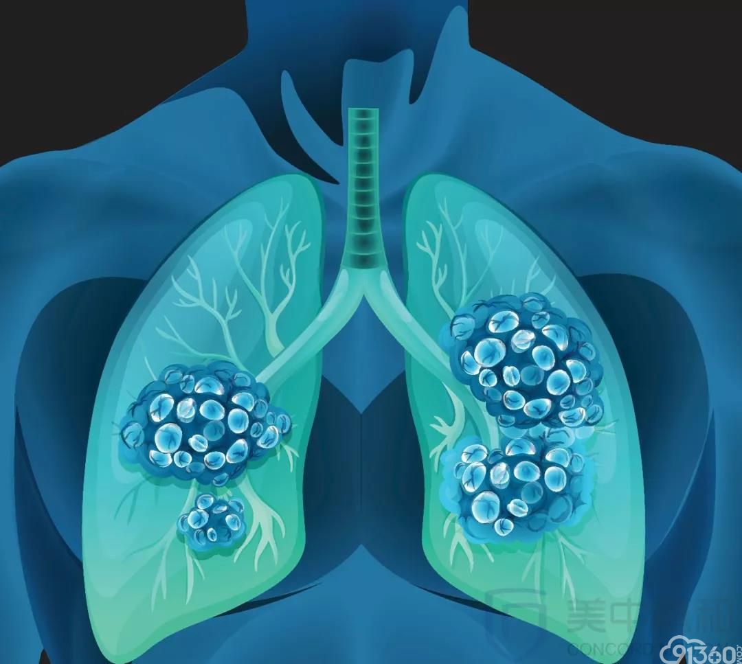 What Is Advanced Lung Cancer